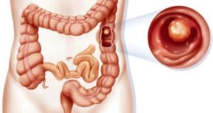 polipos-intestino