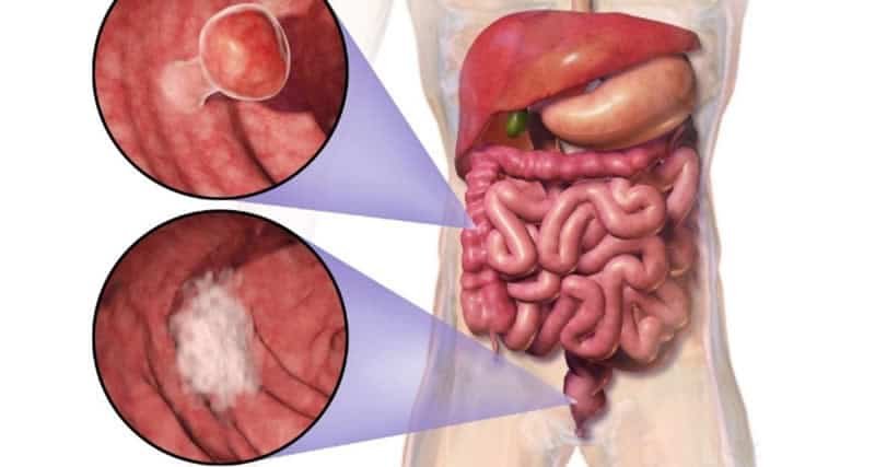 prevencao-e-tratamento-cancer-intestino