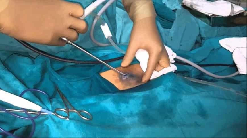 cisto-pilonidal