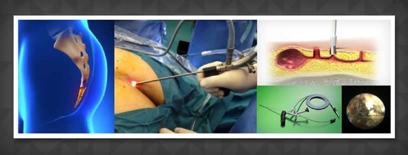 tratamento-epsit-pilonidal