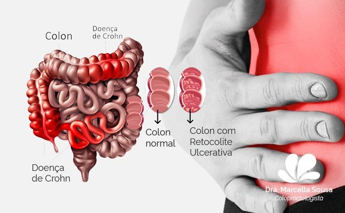 O Que São Doenças Inflamatórias Intestinais Fique De Olho 