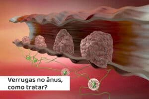 verrugas-no-anus-como-tratar