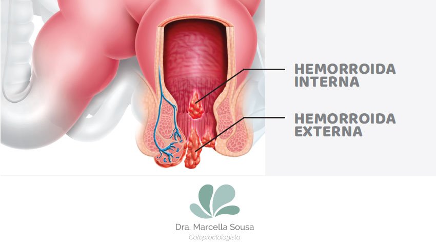 tratamento-caseiro-hemorroida