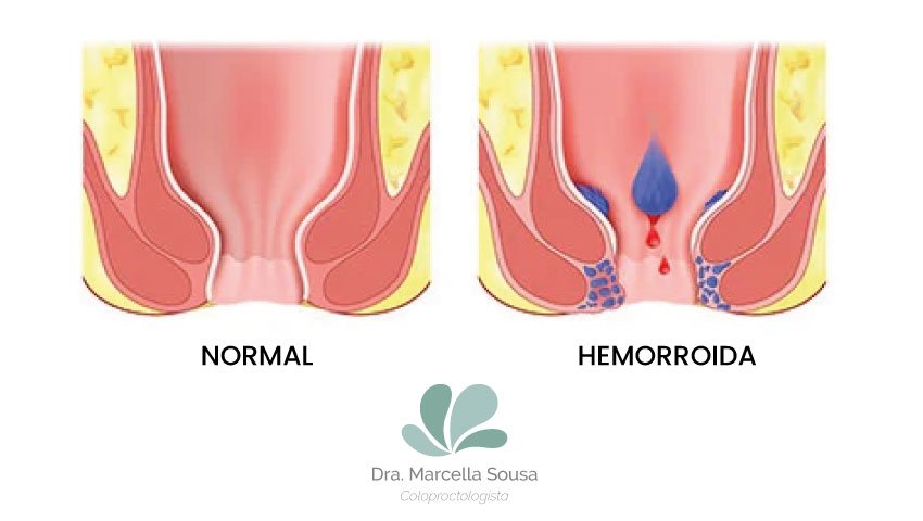 tratamento-hemorroida