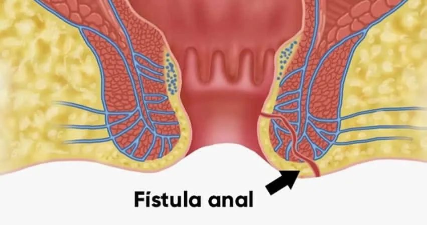 fistula-anal
