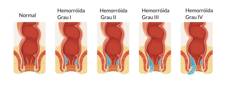 grau-da-hemorroida