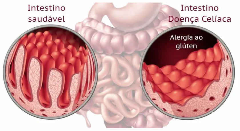 alergia-ao-gluten-doenca-celiaca