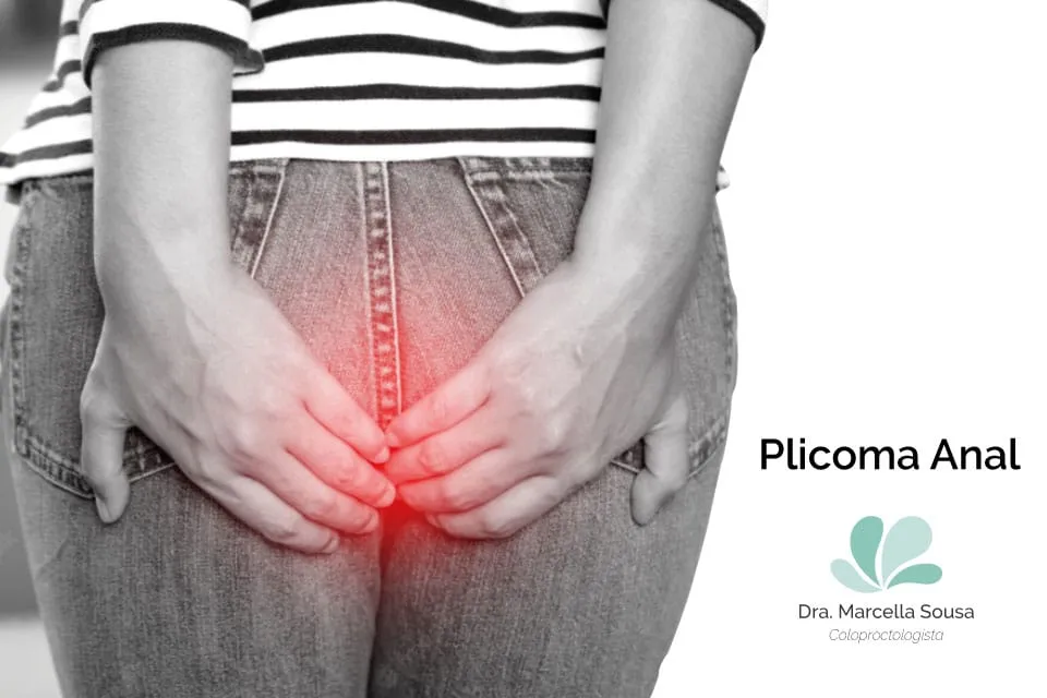 como-tratar-plicoma-anal