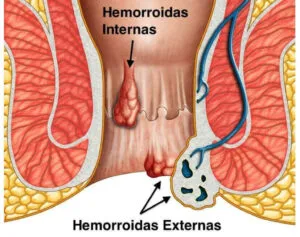 cirurgia-de-hemorroida-interna-e-externa